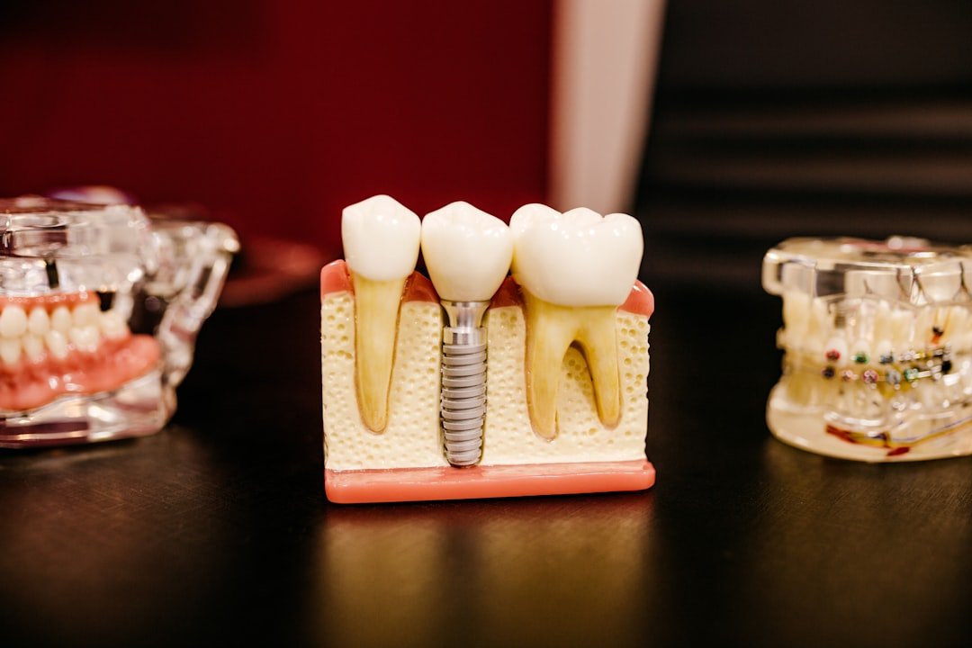 Crafting Captivating Headlines: Your awesome post title goes here dental-implant-model-with-teeth-w9yey6g8lvm